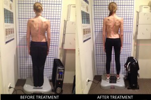 Scoliosis Case Study 5 - Before and After